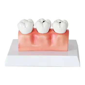 Модель детского кариеса зубов модель здоровья полости рта патологический кариес зубов анатомическая модель